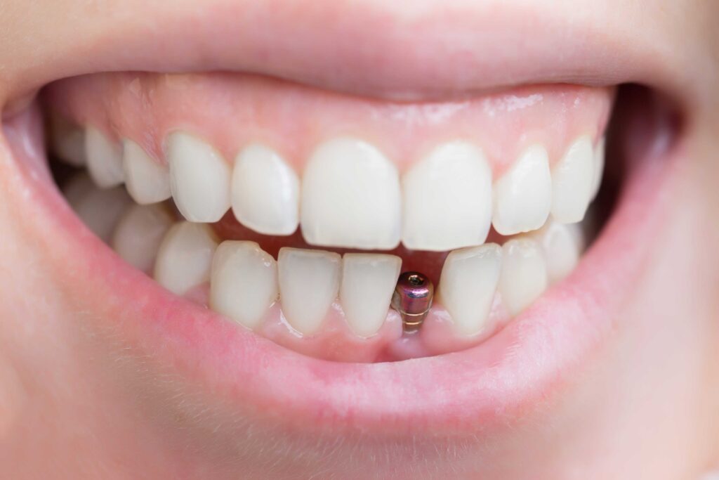 Closeup of a dental implant